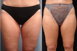thigh-lift-treatment in ISLAMABAD