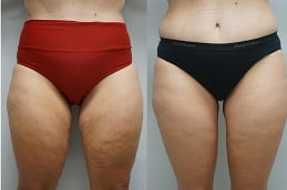 thigh-lift-treatment in rAWALPINDI