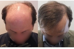 turkish hair transplant in ISLAMABAD