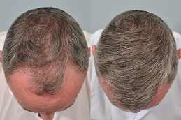 10000 grafts hair transplant cost Clinic in islamabad