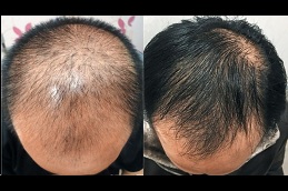 Best cheapest prp hair treatment Clinic in Islamabad