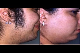 Best face and neck laser hair removal cost Clinic in Islamabad