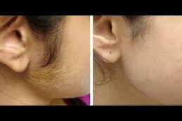 Best face and neck laser hair removal cost in Rawalpindi