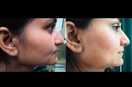Best face laser hair removal price Clinic in Islamabad