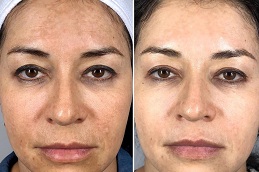 Best fotona 4d for face Clinic in islamabad