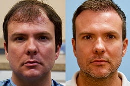 Best fue hair transplant Clinic in islamabad