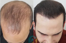 fue hair transplant cost Clinic in Islamabad