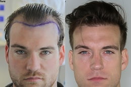 Best fue hair transplant in rawalpindi