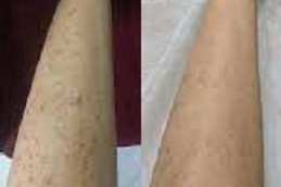 Best full body laser hair removal Clinic in Islamabad