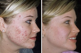 Best interventions for acne Clinic in Islamabad