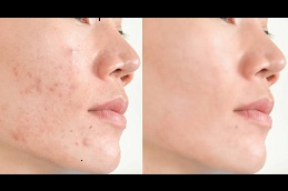 Best interventions for acne in Rawalpindi