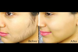 Best laser treatment for hair removal on face price in Rawalpindi