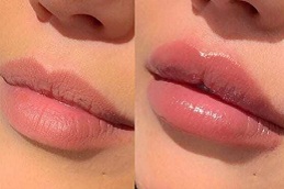 Best lips color treatment in rawalpindi