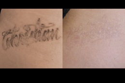 Best picosure tattoo removal Clinic in Islamabad
