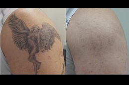 Best picosure tattoo removal in Rawalpindi