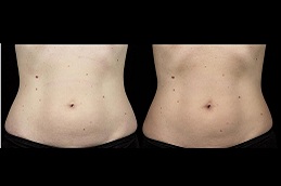 Best sculpsure body contouring Clinic in Islamabad