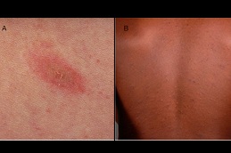 Best skin rashes types causes treatment Clinic in Islamabad