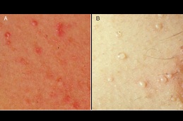 Best skin rashes types causes treatment in Rawalpindi