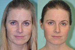 Best spectra laser carbon peel Clinic in Islamabad