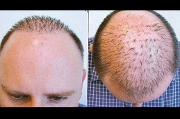Best stages of hair transplant Clinic in Islamabad