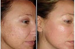 Best sylfirm-x-treatment Clinic in islamabad