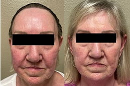 Best sylfirm-x-treatment in rawalpindi