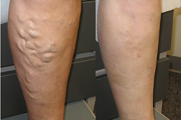 Best varicose veins treatment Clinic in islamabad