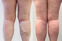 Best varicose veins treatment in rawalpindi