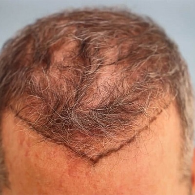 FUE Hair Transplant Cost in Islamabad