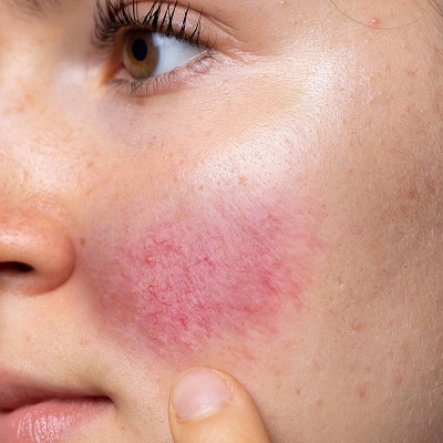 How to Get Rid of Rosacea Permanently in Islamabad & Pakistan Cost
