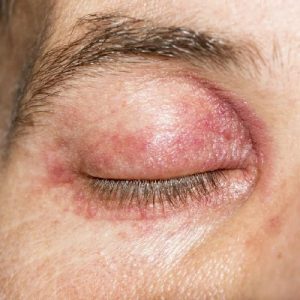 How to Treat Eczema on Eyelids?