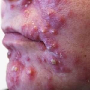 Interventions for Acne in Islamabad