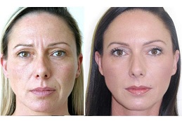 best botox injection price in ISLAMABAD