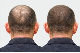 best dermatologist or hair loss in islamabad