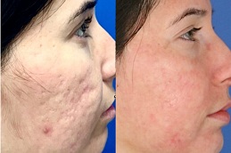 best doctors for acne scars treatment in islamabad