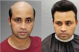 best front line hair fixing in ISLAMABAD