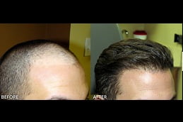 best fue hair transplant in islamabad