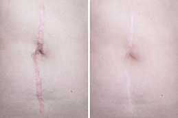 best post-surgical-scars-treatment in islamabad
