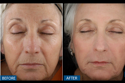 best sylfirm-x-treatment in islamabad