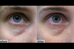 best syringoma removal treatment in ISLAMABAD