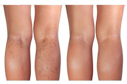 best varicose veins treatment in islamabad