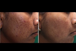 doctors for acne scars treatment in islamabad