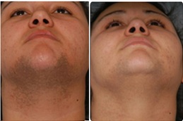 face and neck laser hair removal cost Clinic in Islamabad