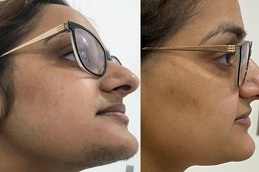 face laser hair removal price Clinic in Islamabad