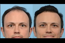 fue hair transplant Clinic in islamabad