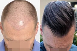 fue hair transplant in islamabad
