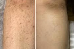 full body laser hair removal Clinic in Islamabad