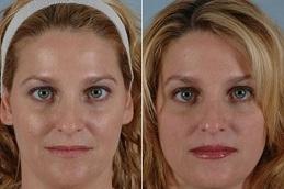 full face botox in rawalpindi
