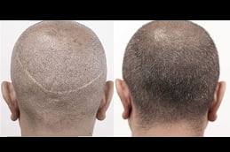 fut-hair-transplant in rawalpindi