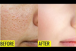 how to reduce pores from face in islamabad
